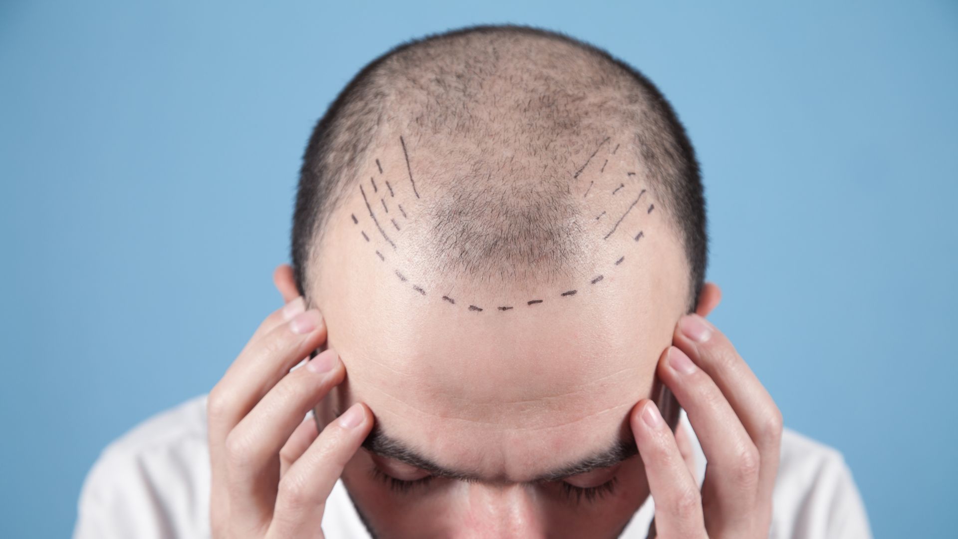 Hair transplantation