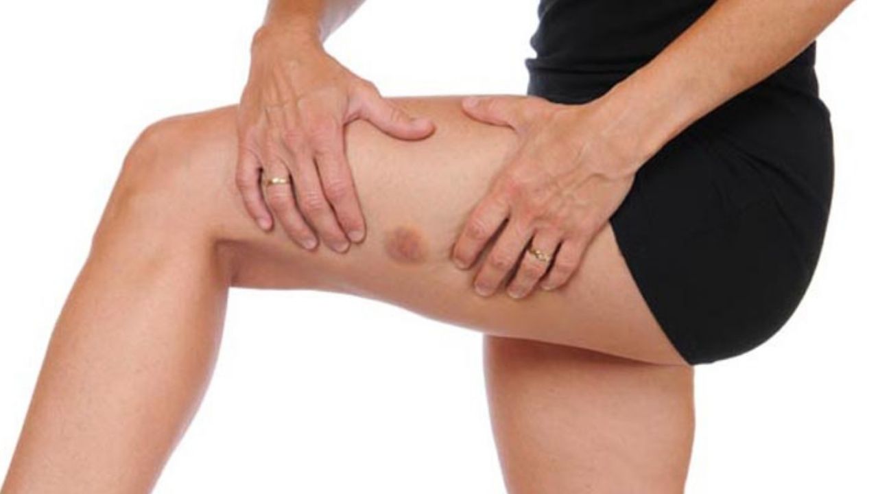 Do you bruise easily? Find out why!!