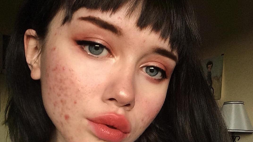 The advice of famous dermatologists, for the treatment of acne