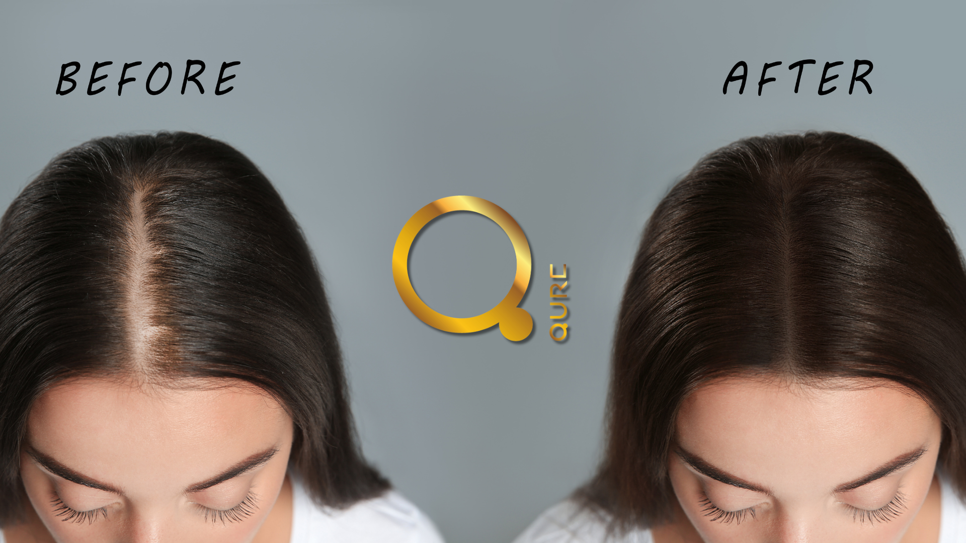 Redensyl εναντίον Minoxidil : Ο απόλυτος οδηγός για θεραπείες κατά τριχόπτωσης
